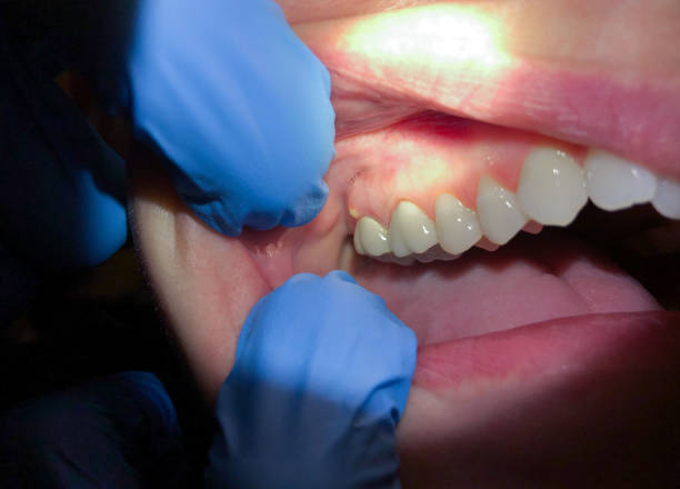 Best Emergency Tooth Extraction in Bayou La Batre, AL
