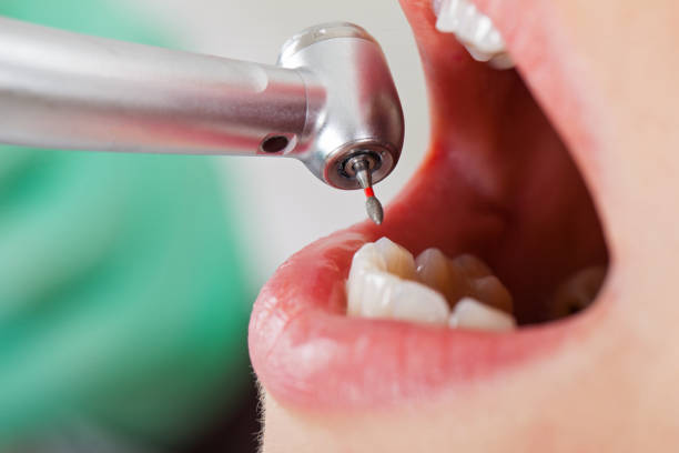 Best Emergency Wisdom Teeth Removal in Bayou La Batre, AL